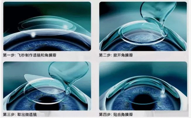 飞秒激光手术.jpg 飞秒激光手术.jpg