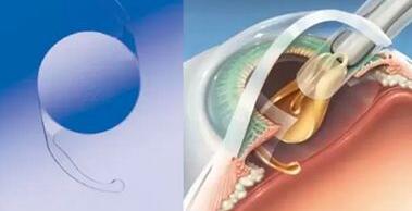 三焦点人工晶体.jpg 三焦点人工晶体.jpg