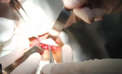 当地的医生跟我说,如果做手术他们只有50%的把握能把我爸眼睛里的东西取出来,而且还不知道会不会伤到眼睛其他部位,我实在是不放心。”刘先生的儿子回忆道。孝顺的儿子不想让爸爸的眼睛承受“50%失败的可能性”,在经过多方打听后,知道福州眼科医院副院长、眼眶病科李谦益主任是这方面的“好手”,他决定带着爸爸到福州寻找 3.jpg 当地的医生跟我说,如果做手术他们只有50%的把握能把我爸眼睛里的东西取出来,而且还不知道会不会伤到眼睛其他部位,我实在是不放心。”刘先生的儿子回忆道。孝顺的儿子不想让爸爸的眼睛承受“50%失败的可能性”,在经过多方打听后,知道福州眼科医院副院长、眼眶病科李谦益主任是这方面的“好手”,他决定带着爸爸到福州寻找 3.jpg