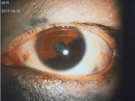 2017年12月11日,脸上“胎记”变恶性肿瘤侵入眼睛的吴先生,在辗转多家医院无从医治的情况下,慕名前来成都牛八体育就诊于罗清礼教授。.jpg 2017年12月11日,脸上“胎记”变恶性肿瘤侵入眼睛的吴先生,在辗转多家医院无从医治的情况下,慕名前来成都牛八体育就诊于罗清礼教授。.jpg