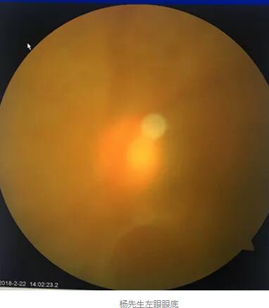 白内障和青光眼都是致盲性眼病,其中青光眼的病程不逆转。杨先生拖延伤情导致同时并发白内障、青光眼的情况,十分令人惋惜。”出名眼科专家、成都牛八体育陈晓明教授表示3.jpg 白内障和青光眼都是致盲性眼病,其中青光眼的病程不逆转。杨先生拖延伤情导致同时并发白内障、青光眼的情况,十分令人惋惜。”出名眼科专家、成都牛八体育陈晓明教授表示3.jpg