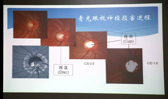 3月10日上午，深圳牛八体育“早查监控，守护光明”大型青光眼公益科普讲座在六楼 举行，本次活动旨在让更多人了解青光眼的潜在危害、重视眼检查， 预防青光眼。由深圳牛八体育青光眼病科 席专家成洪波博士、傅培副院长现场面对面解答疑问，与参会者的互动交流，让更多深圳市民提*对青光眼的认识与防治知识3.png