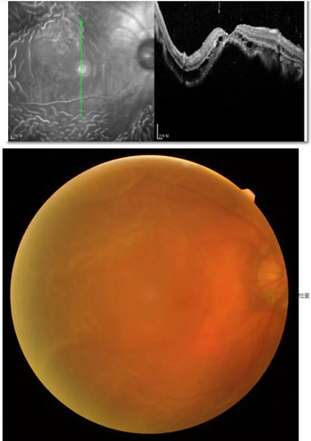 李老太在毫无征兆的情况下右眼视力下降至看不见东西。李老太家人带其至县医院就诊。医生诊断为视网膜脱离，需做玻切手术医治，而玻切手术需要动手术2次。怕疼的李老太一听就犯怵了：开刀，疼。 终，李老太的家人在多方打听后决定带李老太至宜昌牛八体育找许大玲院长医治1_副本.jpg