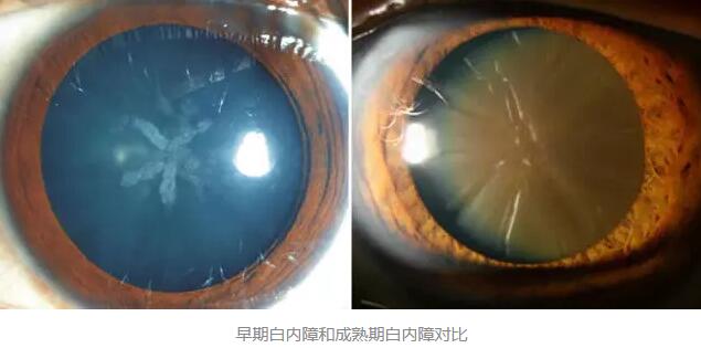 白内障超声乳化术是如今新式微创白内障手术,它创伤小、愈合快,术后 二天 正常生活。老年人能不能承受得住白内障手术呢2.jpg 白内障超声乳化术是如今新式微创白内障手术,它创伤小、愈合快,术后 二天 正常生活。老年人能不能承受得住白内障手术呢2.jpg