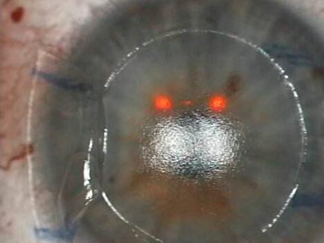 角膜地形图引导的个性化角膜屈光手术可采用角膜表层切削手术方式,即角膜表层屈光手术,如PRK、经上皮准分子激光角膜屈光性切削术(Trans-PRK)、乙醇法准分子激光上皮瓣下角膜磨镶术(LASEK)等;也可采用角膜板层屈光手术,如LASIK、飞秒激光辅助LASIK等2.jpg 角膜地形图引导的个性化角膜屈光手术可采用角膜表层切削手术方式,即角膜表层屈光手术,如PRK、经上皮准分子激光角膜屈光性切削术(Trans-PRK)、乙醇法准分子激光上皮瓣下角膜磨镶术(LASEK)等;也可采用角膜板层屈光手术,如LASIK、飞秒激光辅助LASIK等2.jpg