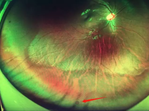 想要摘镜参军在深圳牛八体育查出视网膜裂孔 细心妈妈挽救孩子视网膜1.png