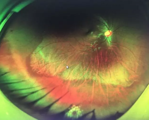 想要摘镜参军在深圳牛八体育查出视网膜裂孔 细心妈妈挽救孩子视网膜2.png