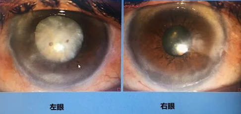 同时患 青光眼、白内障老婆婆辗转几家医院之后终于在成都牛八体育顺利手术2.png 同时患 青光眼、白内障老婆婆辗转几家医院之后终于在成都牛八体育顺利手术2.png