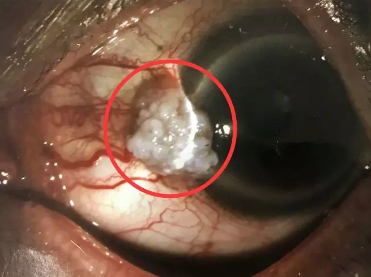 吴护平教授坐诊福州眼科医院 为角膜肿瘤患者顺利手术2.png 吴护平教授坐诊福州眼科医院 为角膜肿瘤患者顺利手术2.png