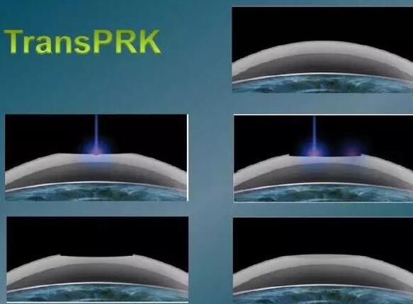 高考心仪 视力严格要求?可以通过这些术式摘镜2.jpg 高考心仪 视力严格要求?可以通过这些术式摘镜2.jpg