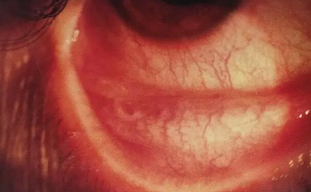 患者工地施工不慎水泥进眼里导致白内障在漳州眼科医院顺利手术1.jpg 患者工地施工不慎水泥进眼里导致白内障在漳州眼科医院顺利手术1.jpg