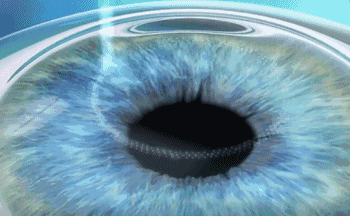 想要当兵视力不达标怎么办?牛八体育有这些摘镜术式帮助你1.gif 想要当兵视力不达标怎么办?牛八体育有这些摘镜术式帮助你1.gif