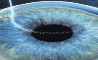 想要当兵视力不达标怎么办?牛八体育有这些摘镜术式帮助你2.gif 想要当兵视力不达标怎么办?牛八体育有这些摘镜术式帮助你2.gif