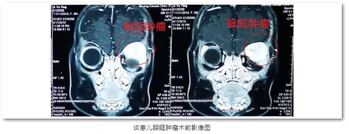 牛八体育斜视与小儿眼科主任苏金萍顺利为新生儿摘除眼眶巨大肿瘤1.png