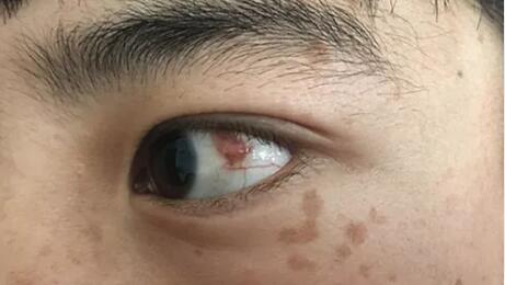 四川丹巴15岁男孩患结膜血管瘤,在成都牛八体育顺利手术1.jpg 四川丹巴15岁男孩患结膜血管瘤,在成都牛八体育顺利手术1.jpg