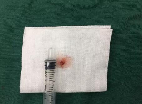 四川丹巴15岁男孩患结膜血管瘤,在成都牛八体育顺利手术3.jpg 四川丹巴15岁男孩患结膜血管瘤,在成都牛八体育顺利手术3.jpg