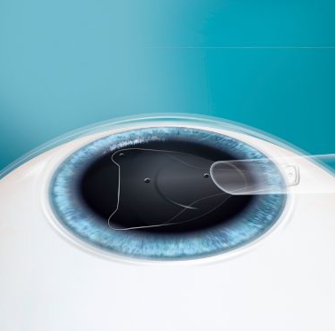 牛八体育课堂ICL晶体植入术2.png 牛八体育课堂ICL晶体植入术2.png