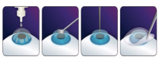 近视无法根治?但你可以这样做?牛八体育“有爱就有希望”近视手术火热进行中1.png 近视无法根治?但你可以这样做?牛八体育“有爱就有希望”近视手术火热进行中1.png