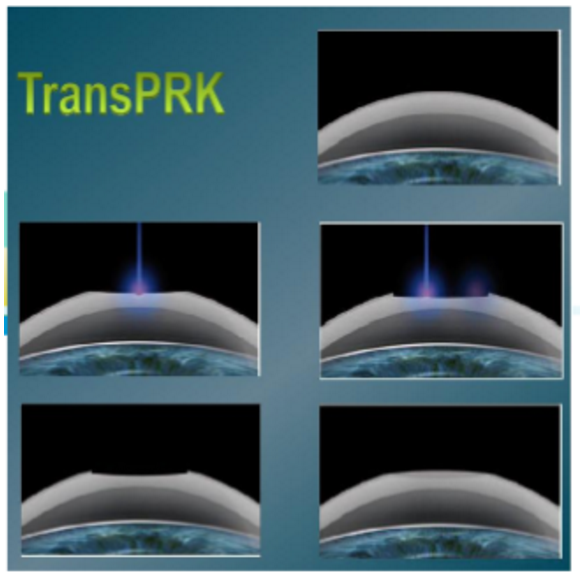近视无法根治?但你可以这样做?牛八体育“有爱就有希望”近视手术火热进行中3.png 近视无法根治?但你可以这样做?牛八体育“有爱就有希望”近视手术火热进行中3.png