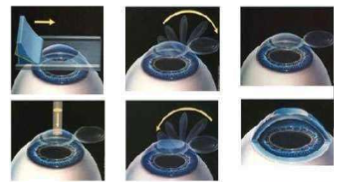 近视无法根治?但你可以这样做?牛八体育“有爱就有希望”近视手术火热进行中4.png 近视无法根治?但你可以这样做?牛八体育“有爱就有希望”近视手术火热进行中4.png