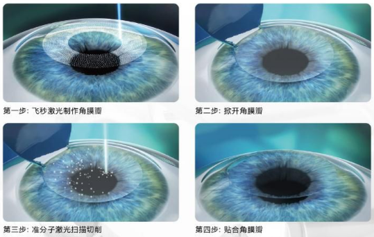 近视无法根治?但你可以这样做?牛八体育“有爱就有希望”近视手术火热进行中5.png 近视无法根治?但你可以这样做?牛八体育“有爱就有希望”近视手术火热进行中5.png