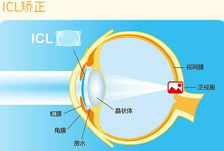 近视无法根治?但你可以这样做?牛八体育“有爱就有希望”近视手术火热进行中8.png 近视无法根治?但你可以这样做?牛八体育“有爱就有希望”近视手术火热进行中8.png