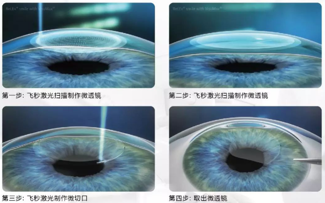 2020高考视力受限专业有哪些?来听听牛八体育近视手术医生的建议1.png 2020高考视力受限专业有哪些?来听听牛八体育近视手术医生的建议1.png